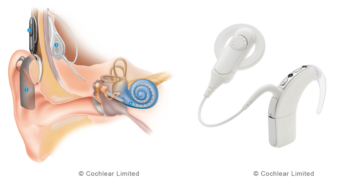 Cochlea_Implantat_0104